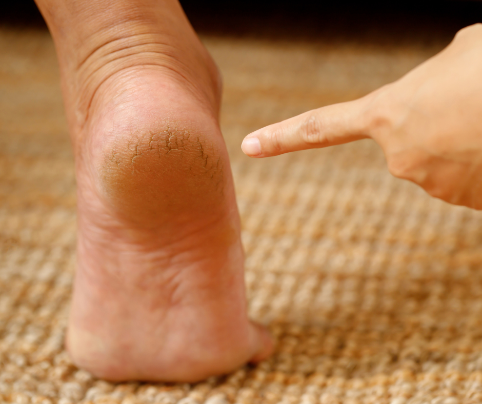Hvorfor får jeg hård hud på hælene?