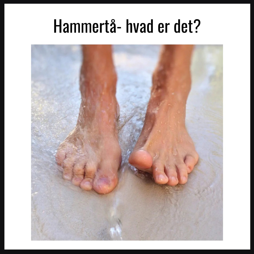 Til dig, der har hammertå